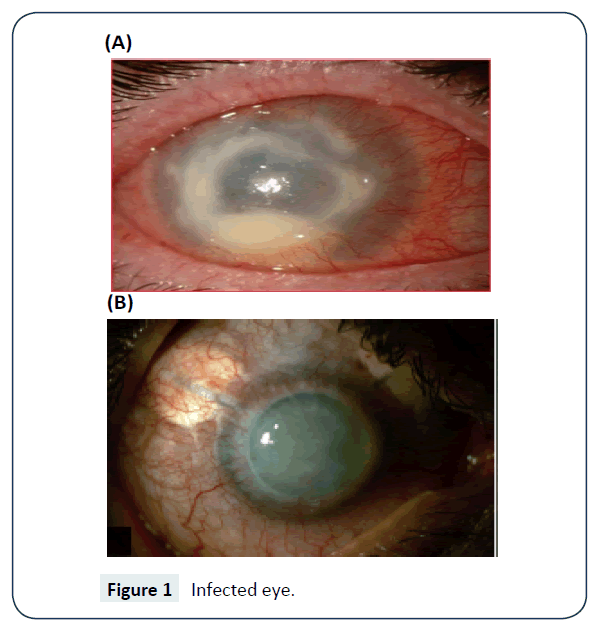 rare-disorders-diagnosis-therapy-Infected-eye