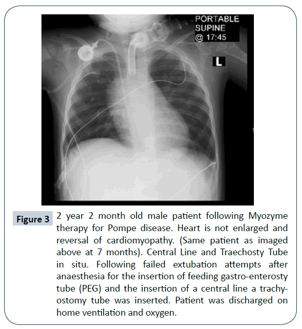 rare-disorders-diagnosis-therapy-Traechosty-Tube