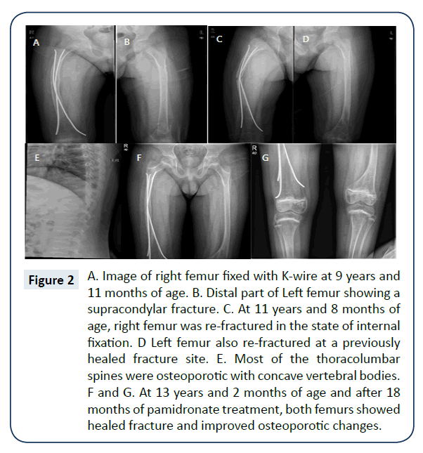 rare-disorders-diagnosis-therapy-right-femur