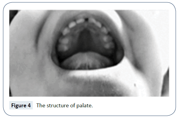 rare-disorders-diagnosis-therapy-structure-palate