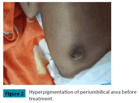 raredisorders-Hyperpigmentation-periumbilical-area