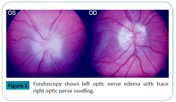 raredisorders-left-optic-nerve